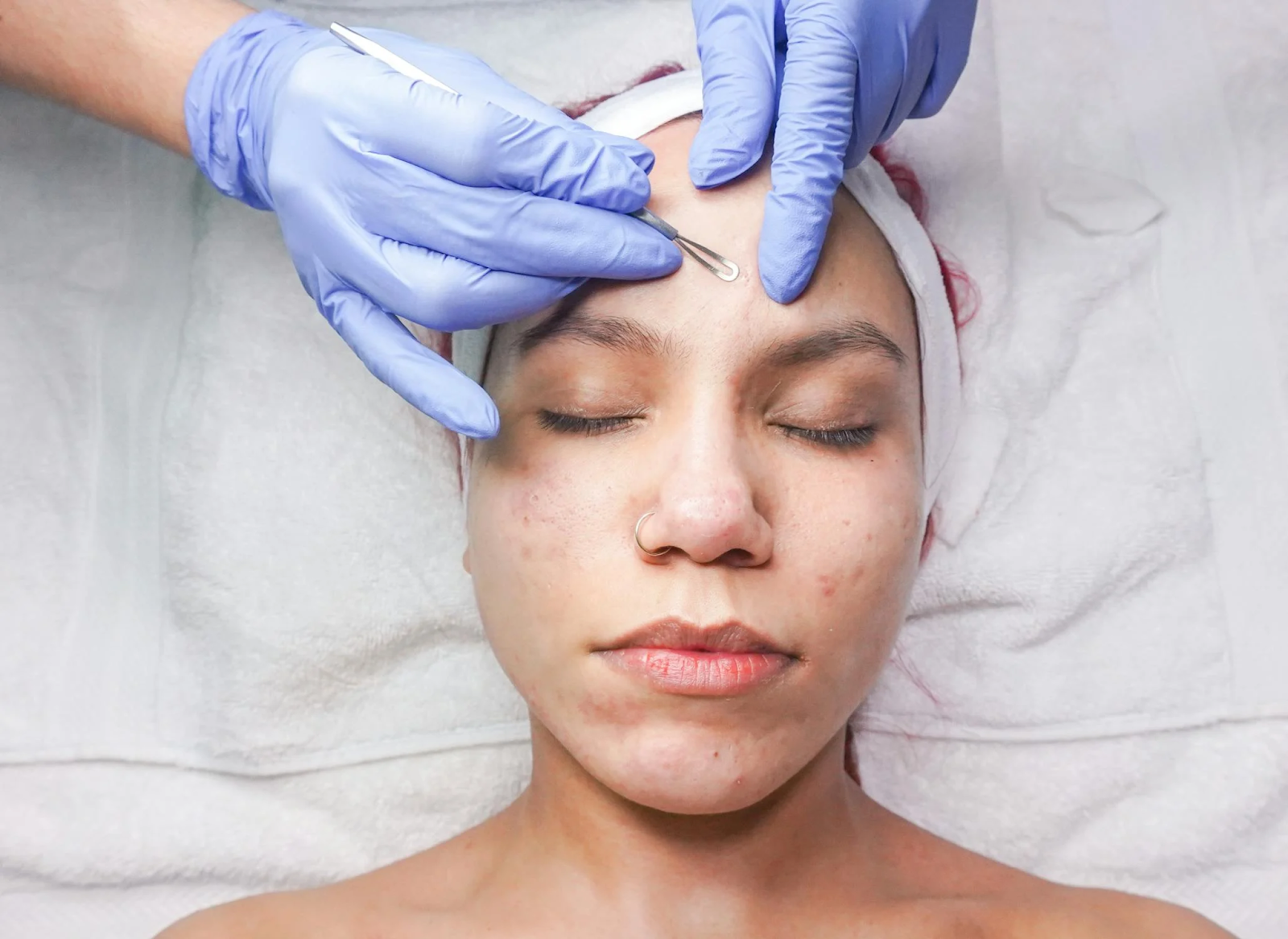 Common Mistakes Blocking Your Path to Clear Skin